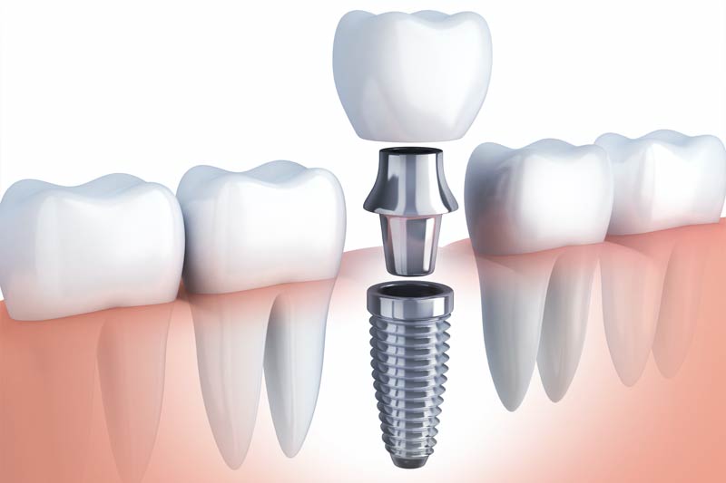 Dental Implants in New York