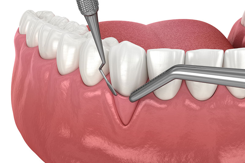 Pinhole Gum Surgery in New York